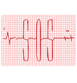 An illustration of a heart-monitor graph showing S-O-S spelled out